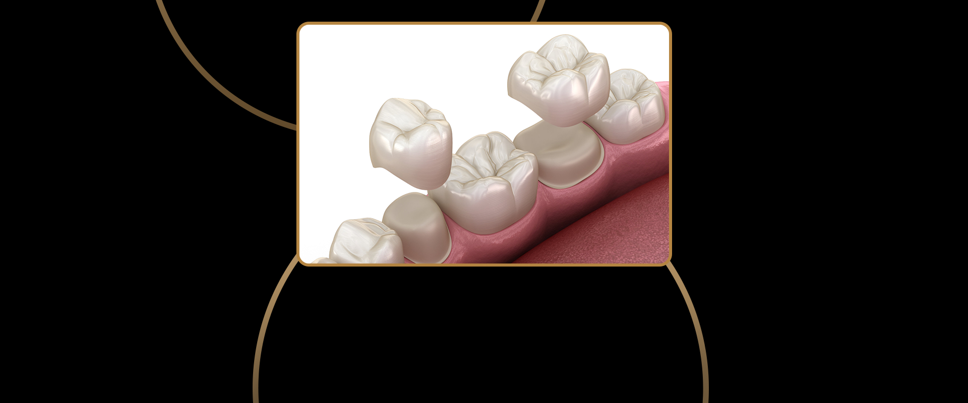 Dental Crowns